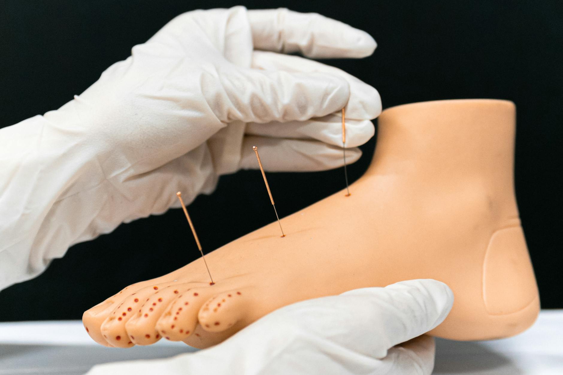 Acupuncture for Knee Osteoarthritis — Evidence-Based Alternative Therapy 2026 Acupuncture needles inserted for pain relief as a knee replacement alternative