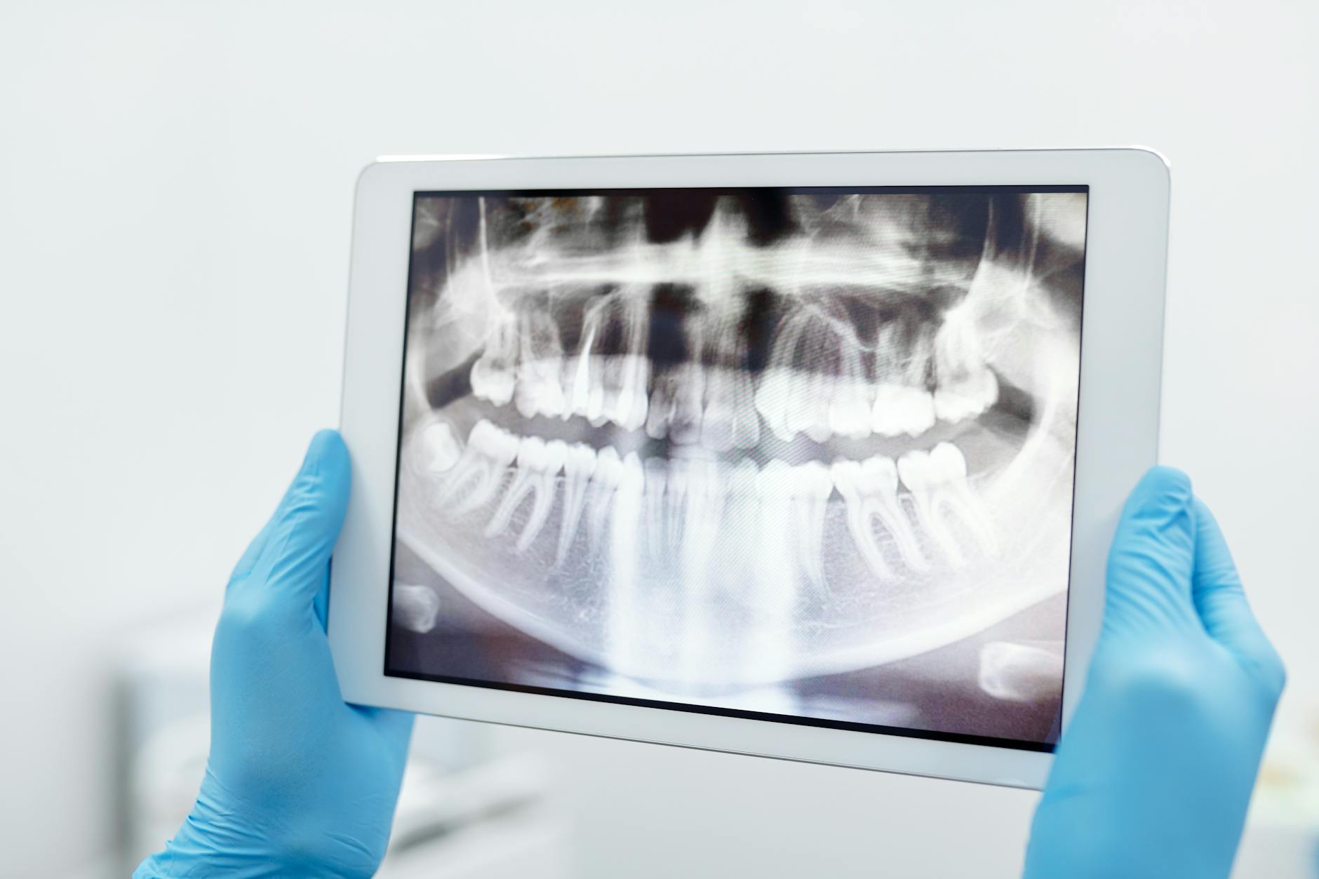 Dental X-Ray Review for Diagnosing Tooth Decay Stages Dentist reviewing dental X-ray on tablet to identify hidden tooth decay between teeth