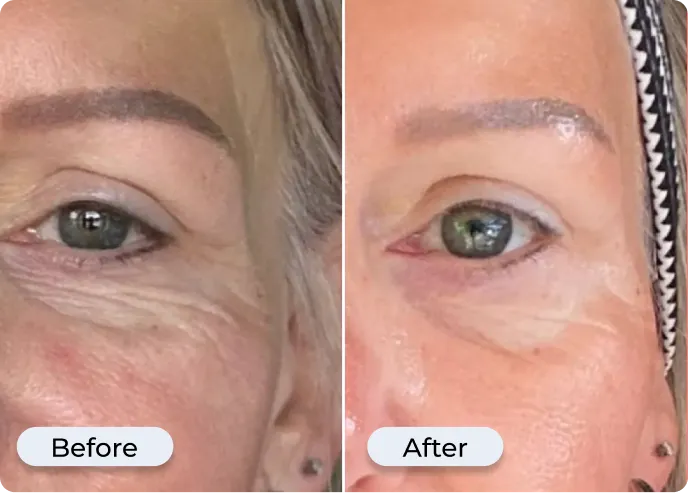 Glamory MicroLift System before and after — 30-day results Glamory MicroLift System before and after results — skin firming and fine line reduction