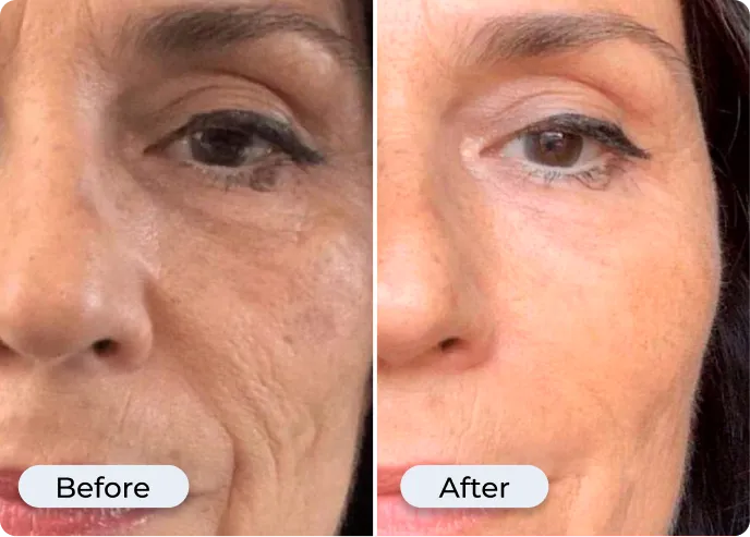 Glamory MicroLift System in use — at-home micro infusion treatment Glamory MicroLift System being used on face — micro infusion device at home demonstration