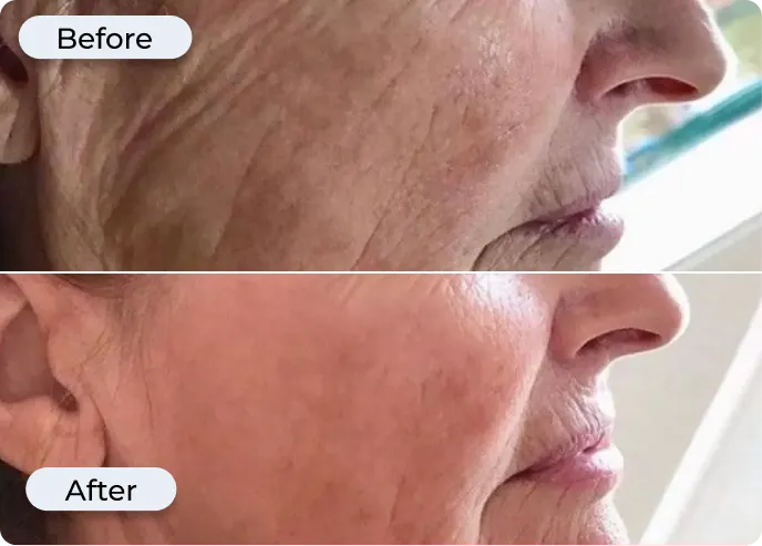 Glamory MicroLift System 30-day results showcase 2026 Glamory MicroLift System results — improved skin radiance, firmness, and fine line reduction after 30 days