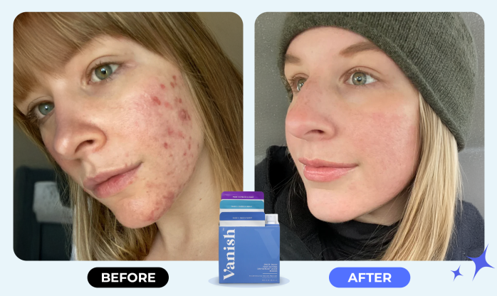 Vanish DrySerum Acne Mask Review 2026: Does It Work?