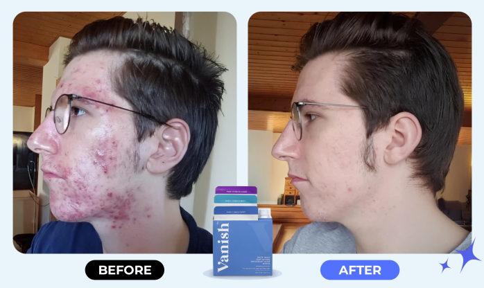 Vanish DrySerum Before and After Results 2026 Vanish DrySerum before and after results showing acne improvement after consistent use