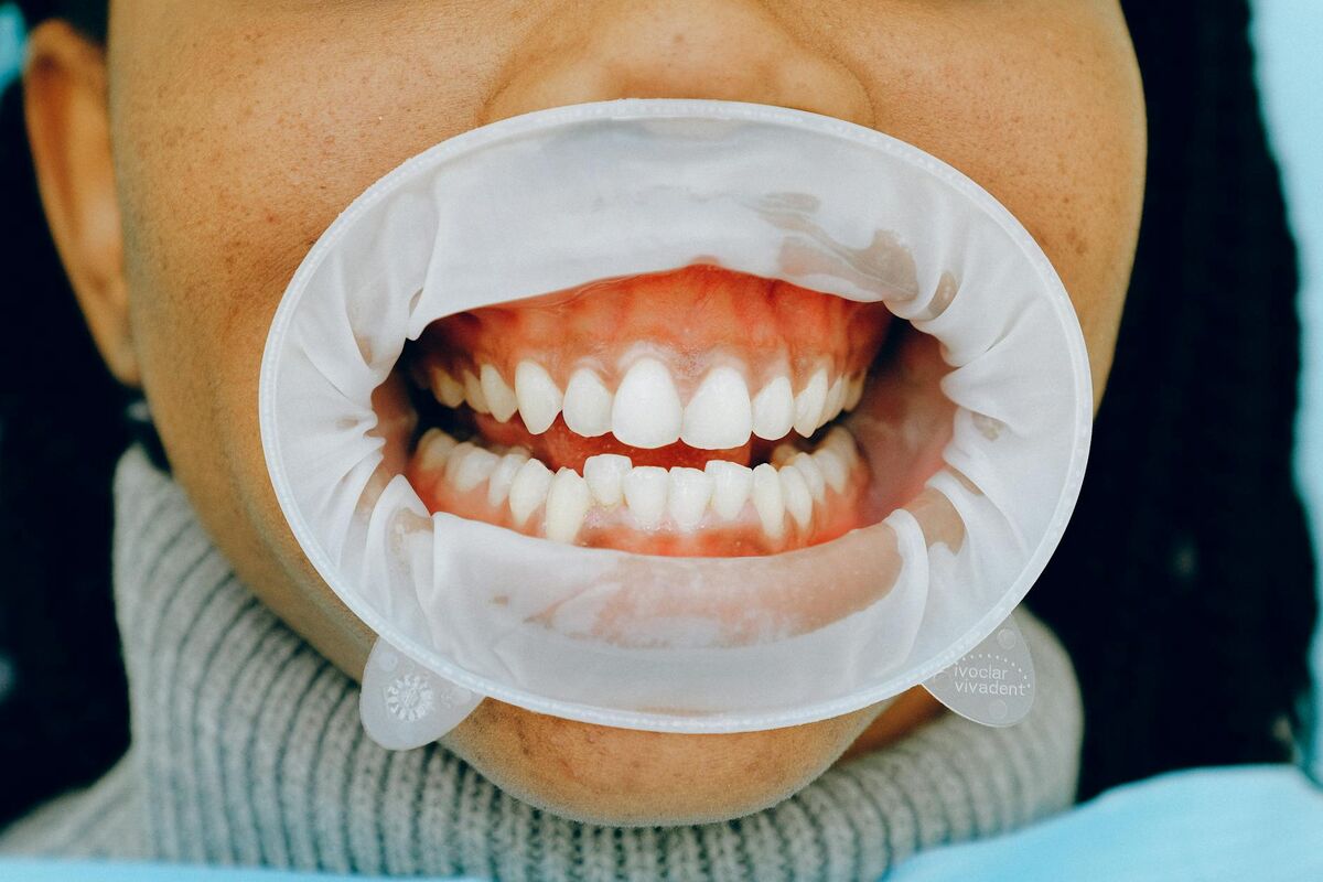 Dental Examination for Gum Health Dental examination showing open mouth and gum tissue during a checkup